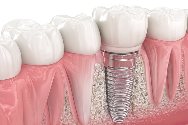 インプラント治療のイメージ